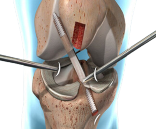 Copia de Se introducen los instrumentos en la articulación de la rodilla y se reparan los tejidos lesionados (3)